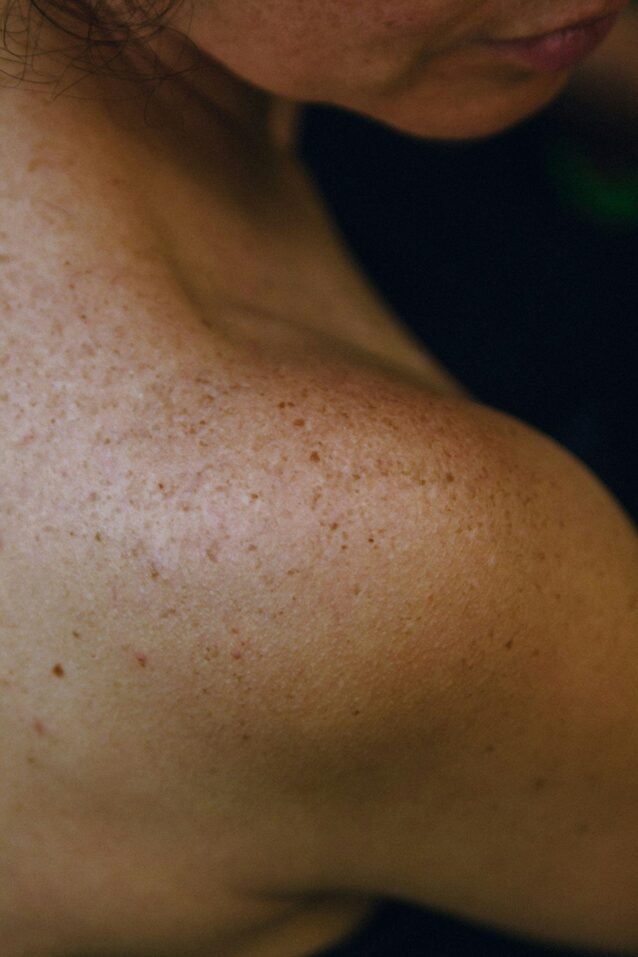 Close-up shot of skin showing uneven texture and subtle hyperpigmentation with freckles and sun spots visible against a dark background. Natural lighting emphasizes the varying skin tones and surface irregularities.